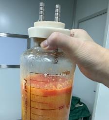 鹰潭水动力吸脂手术要做多久？